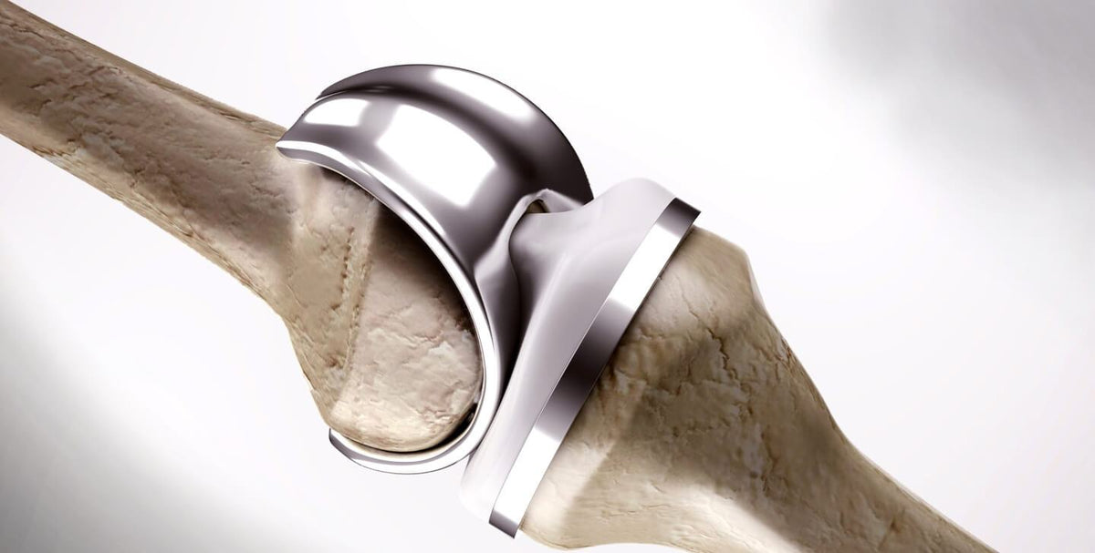 Knee Replacement Recovery: How Would a Spartan Do It?